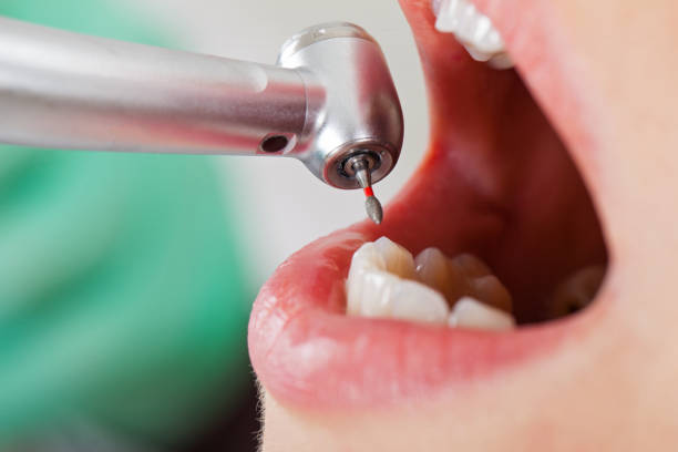 Best Emergency Tooth Extraction in Southern Pines, NC
